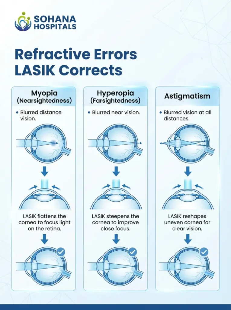 How LASIK Corrects Myopia, Hyperopia, and Astigmatism