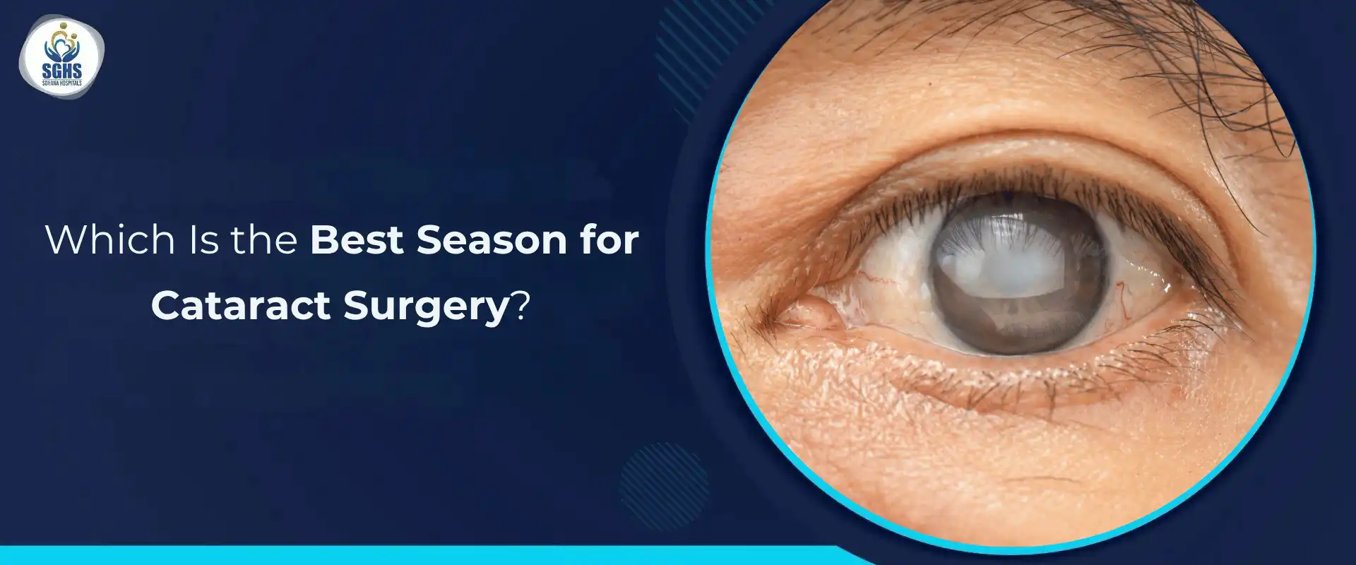 Best Season for Cataract Surgery