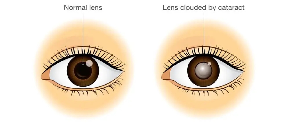 Normal Eye Lens vs. Cataract Clouded Lens