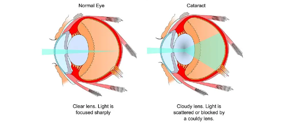 Light on Normal Lens vs. Light on Cataract Clouded Lens