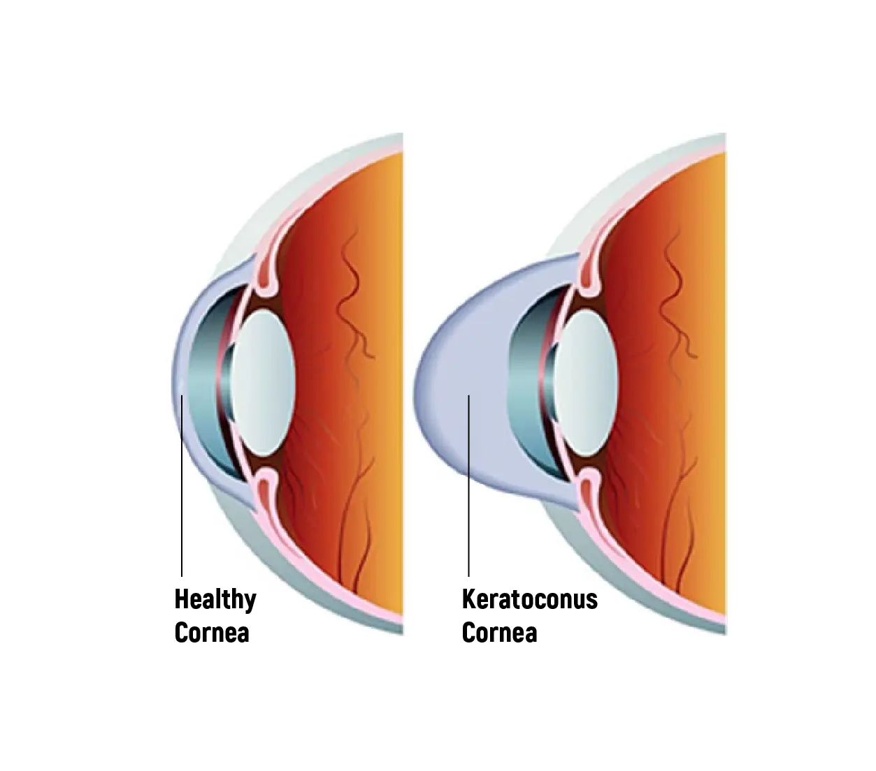 Healthy Cornea and Keratoconus Cornea