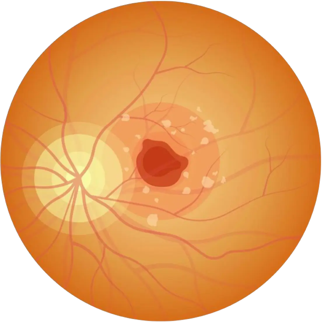Macular Edema problem