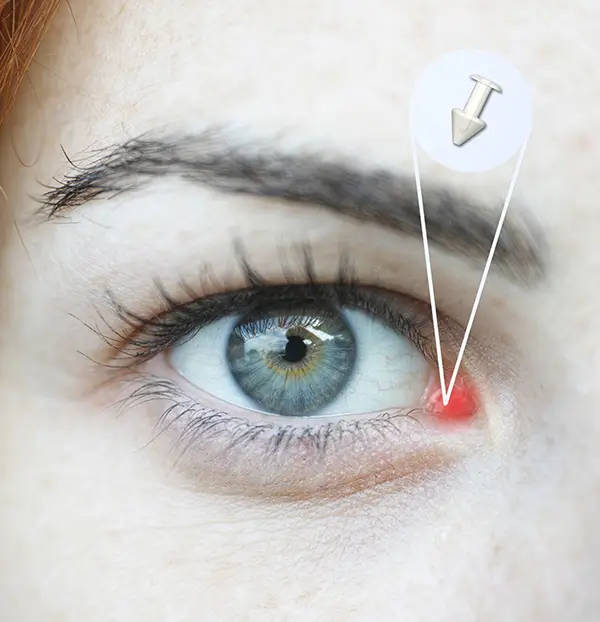 Punctal Plugs for Dry Eye