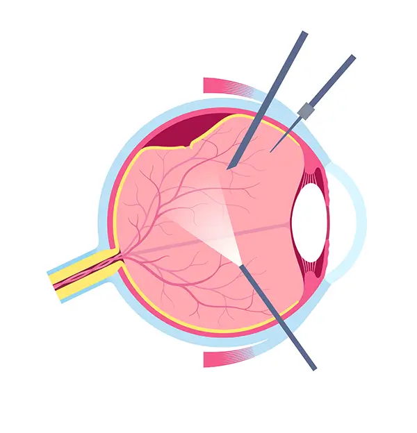 Vitrectomy