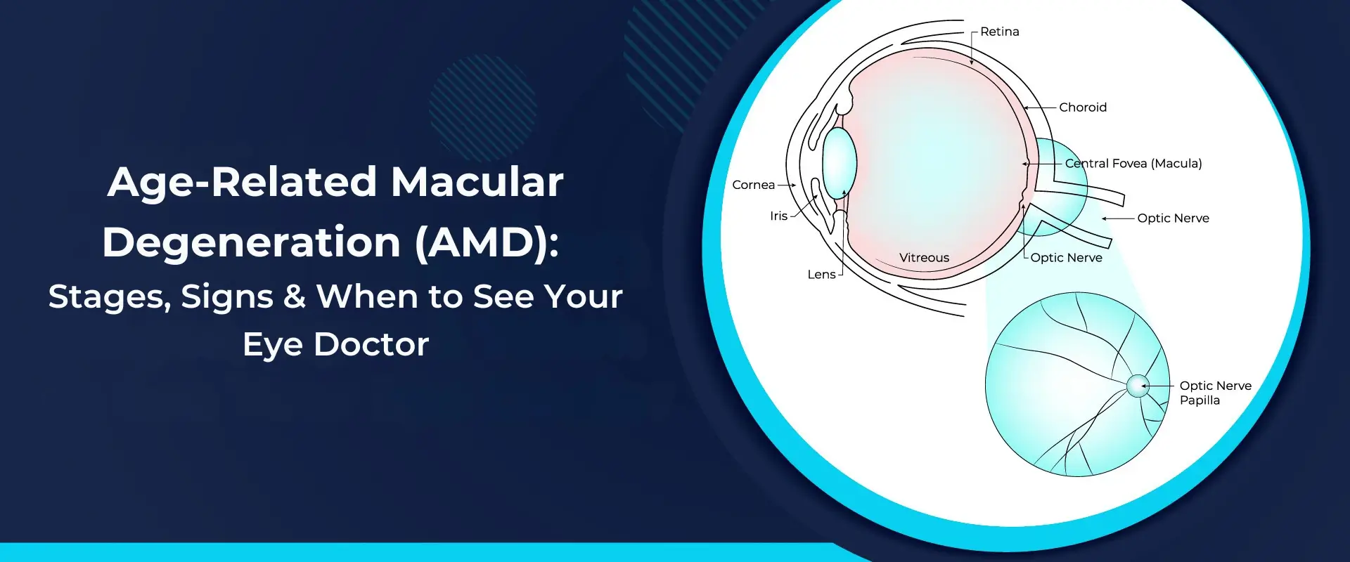 Age-Related Macular Degeneration (AMD) -Stages, Signs & When to See Your Eye Doctor