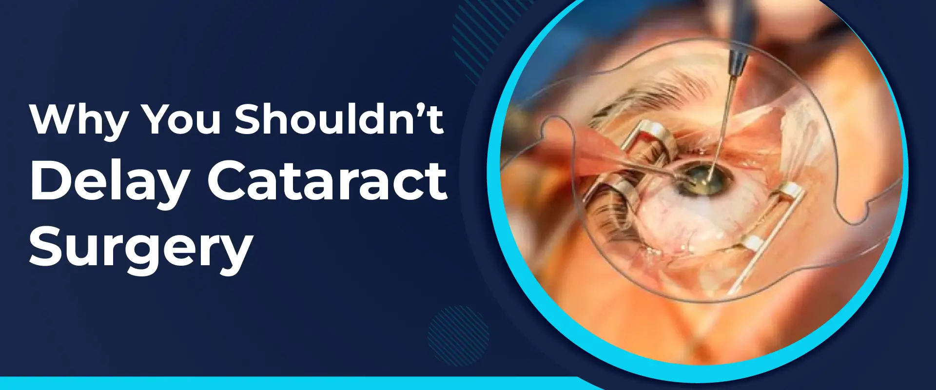Why You Should not Delay Cataract Surgery