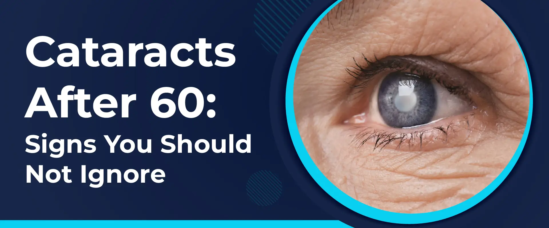 Cataracts