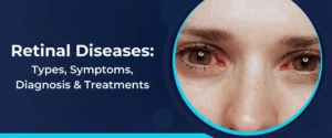 Retinal Diseases