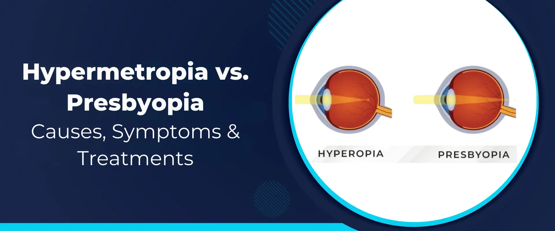 Hypermetropia vs. Presbyopia: Causes, Symptoms & Treatments