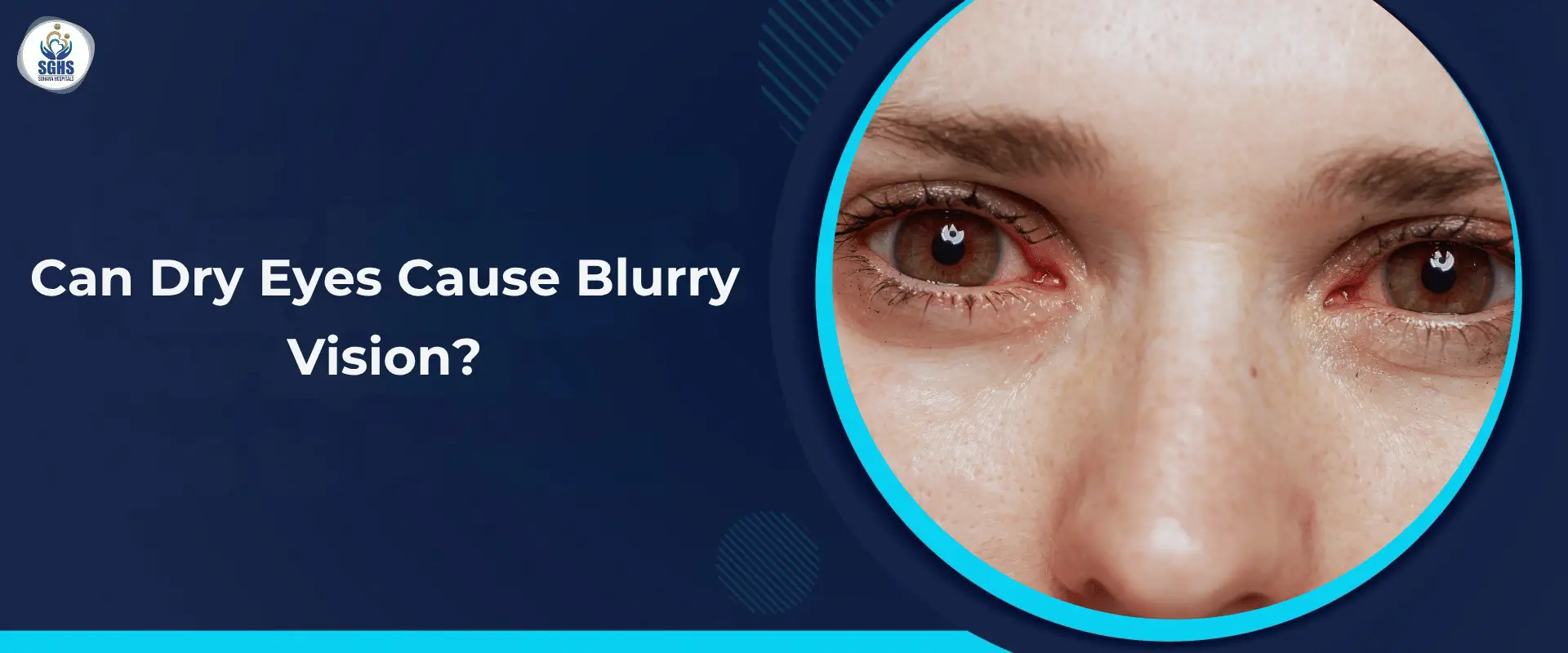 Can Dry Eyes Cause Blurry Vision