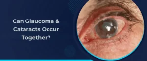 Can Glaucoma and Cataracts Occur Together