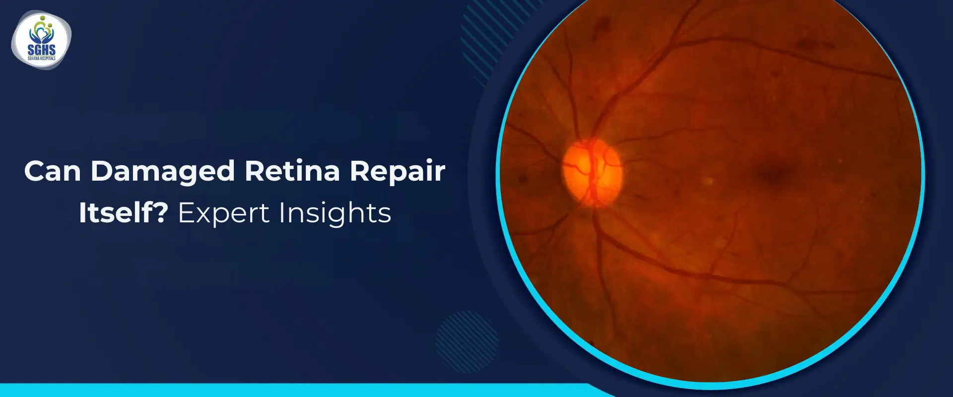 Can Damaged Retina Repair Itself - Expert Insights
