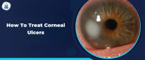 How To Treat Corneal Ulcers