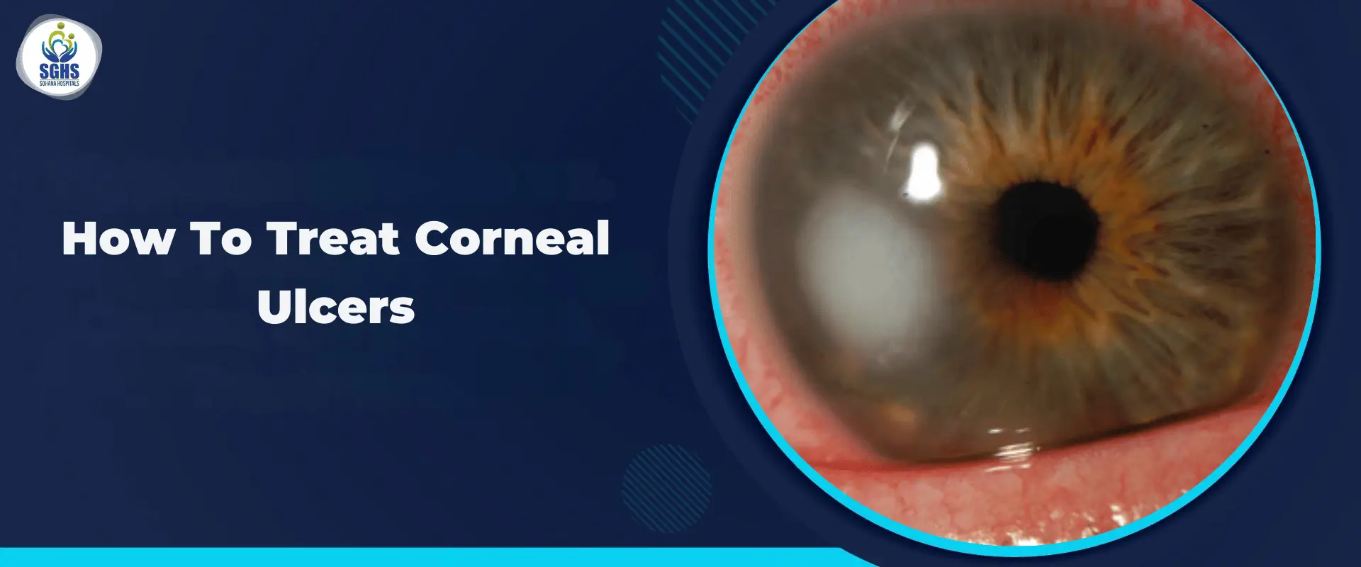 How To Treat Corneal Ulcers