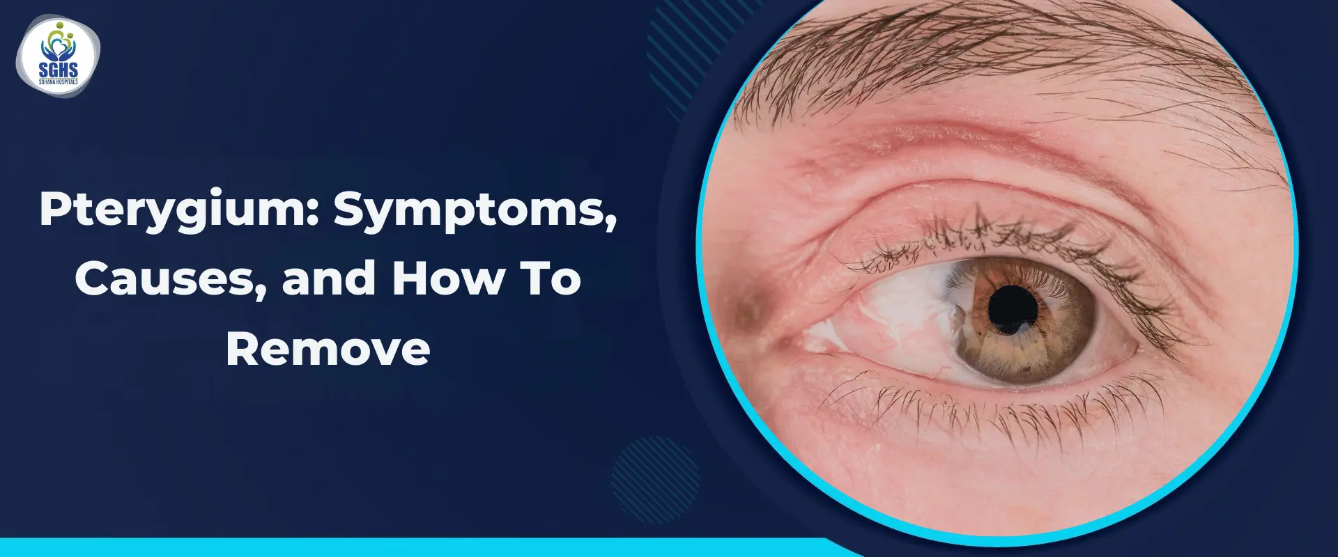 Pterygium - Symptoms, Causes, and How To Remove