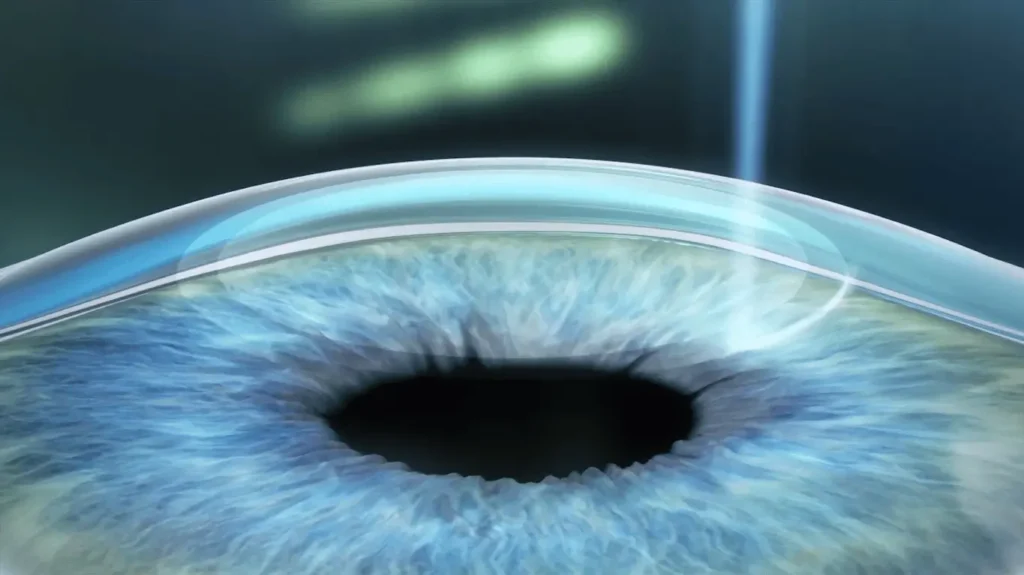 Small Lens-shaped Disc or Lenticule is Created in the Cornea with Femtosecond Laser - Smile Pro Surgery Procedure