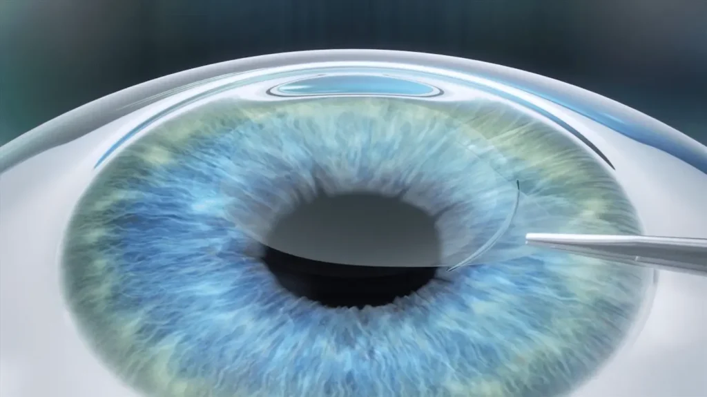 2-4mm small incision created and lenticule extracted in Smile Pro surgery procedure.
