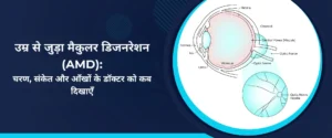 उम्र से जुड़ा मैकुलर डिजनरेशन (AMD) - चरण, संकेत और आँखों के डॉक्टर को कब दिखाएँ