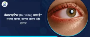 केराटाइटिस (Keratitis) क्या है - लक्षण, प्रकार, कारण, बचाव और इलाज