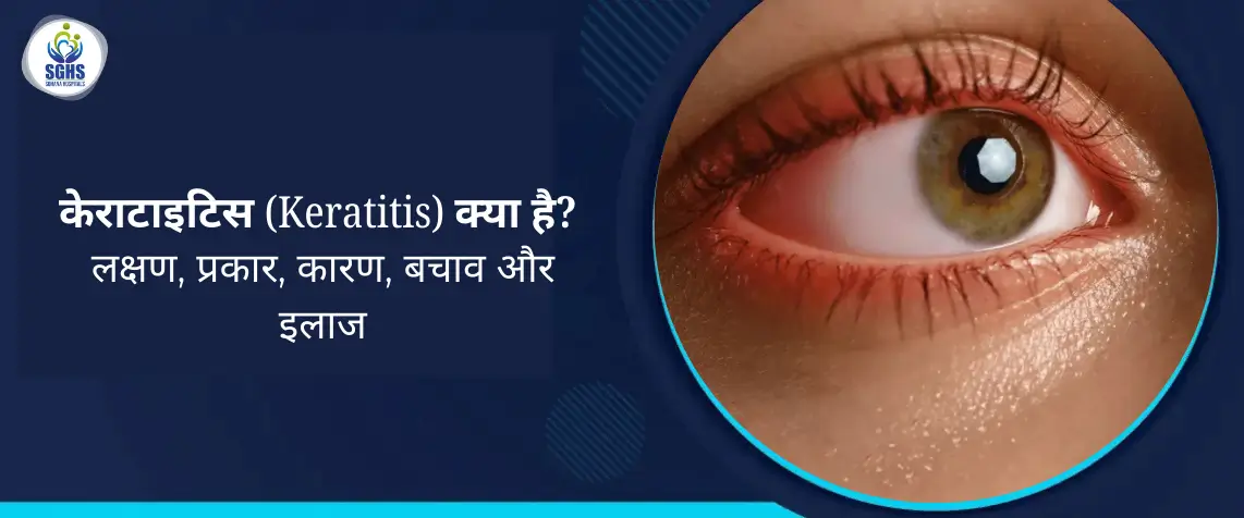 केराटाइटिस (Keratitis) क्या है - लक्षण, प्रकार, कारण, बचाव और इलाज