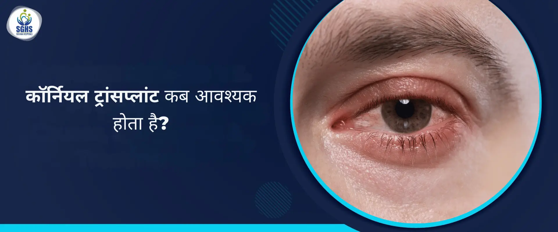 कॉर्नियल ट्रांसप्लांट कब आवश्यक होता है