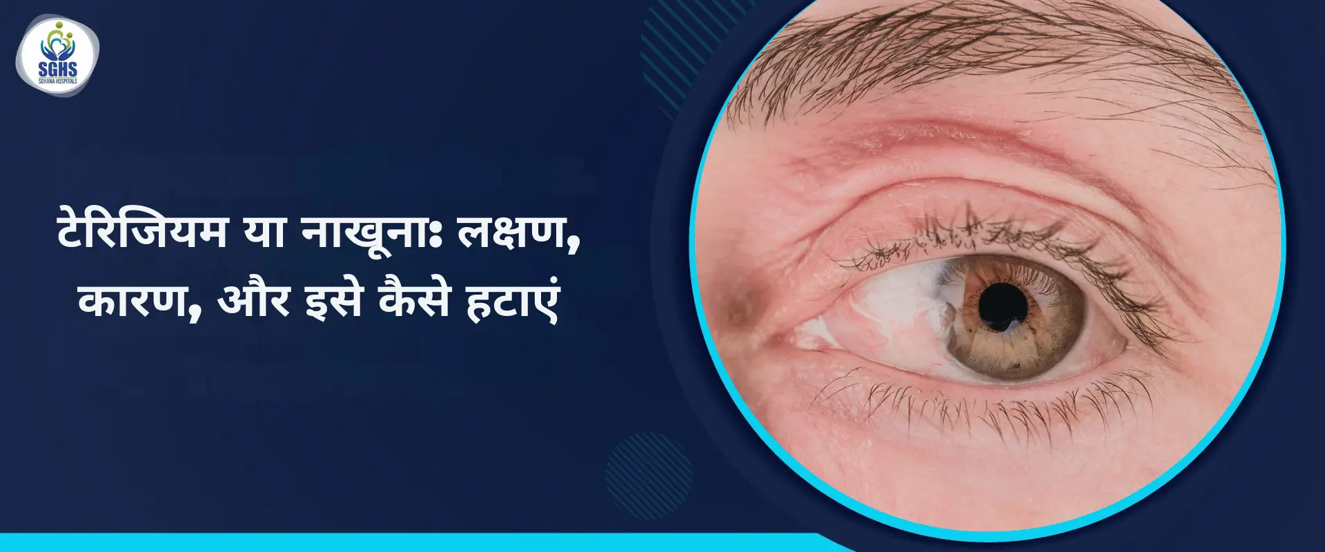 टेरिजियम या नाखूना - लक्षण, कारण, और इसे कैसे हटाएं