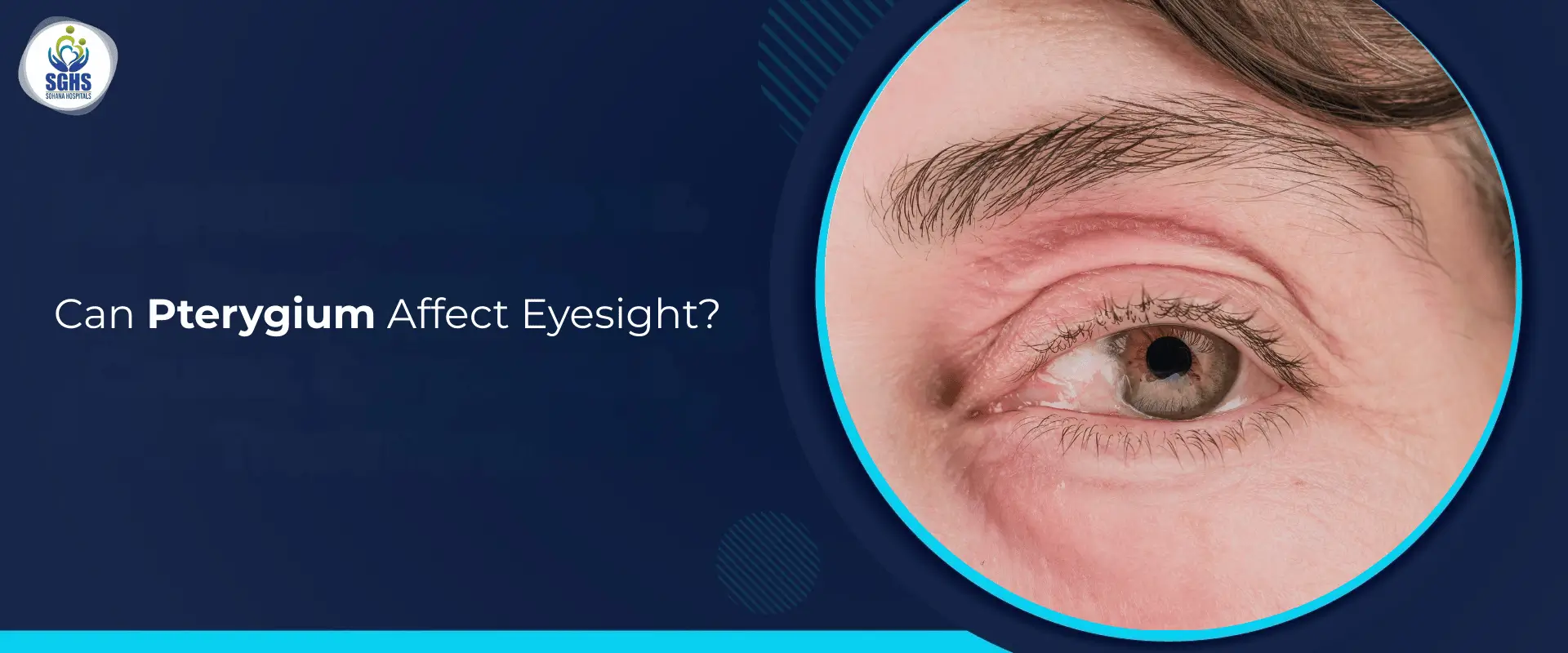 Can Pterygium Affect Eyesight