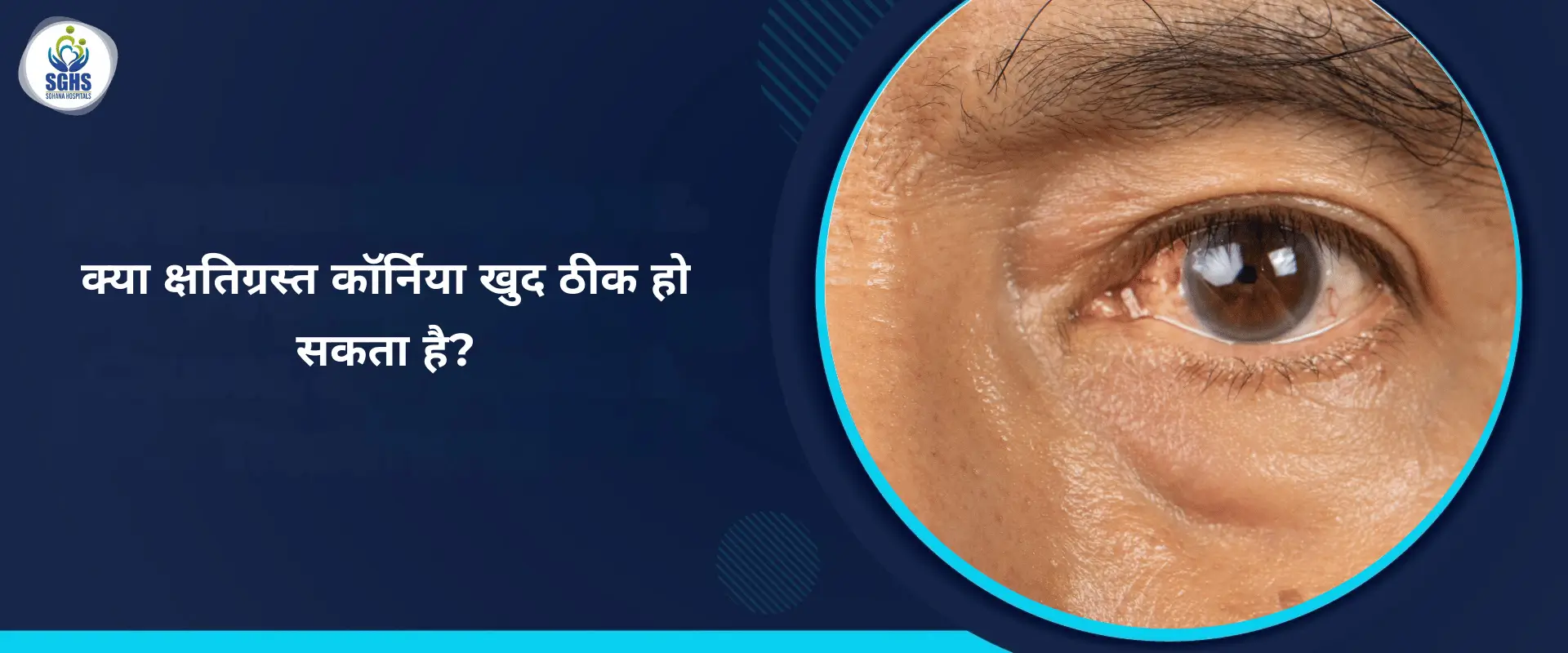 क्या क्षतिग्रस्त कॉर्निया स्वयं ठीक हो सकता है