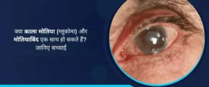 क्या काला मोतिया (ग्लूकोमा) और मोतियाबिंद एक साथ हो सकते हैं