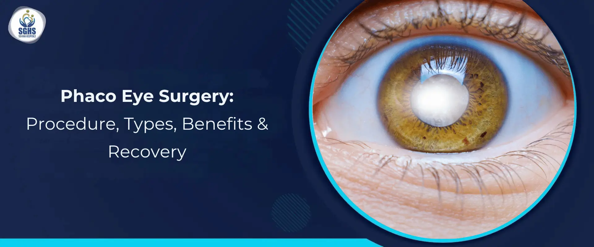 Phaco Eye Surgery