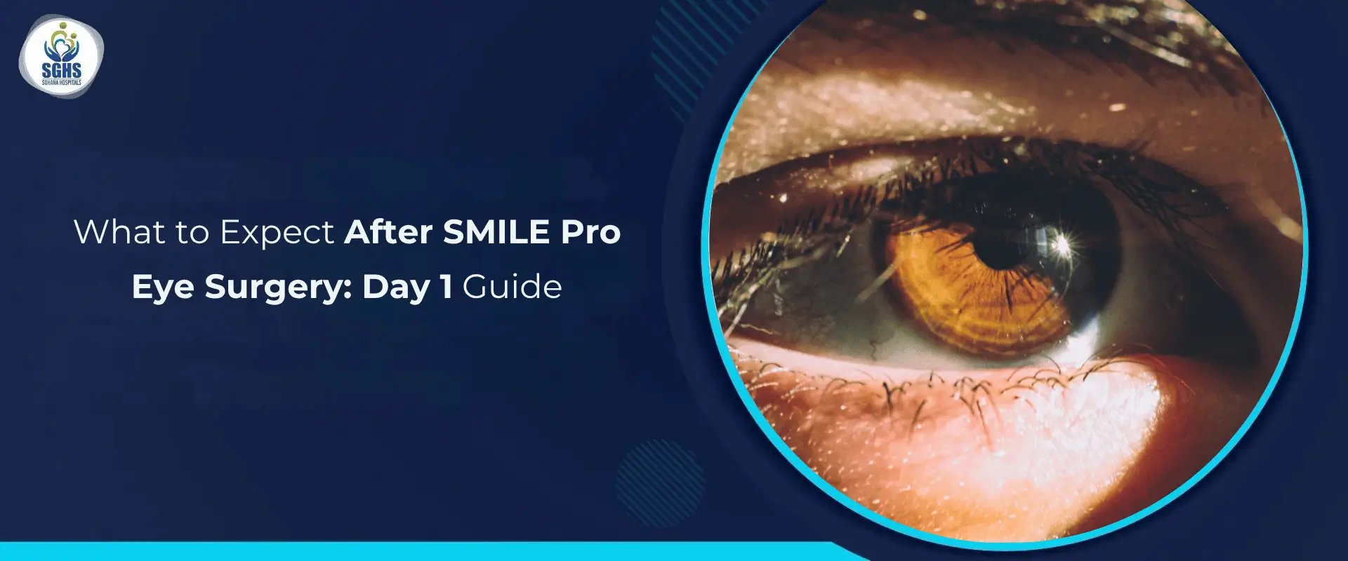 What to Expect After SMILE Pro Eye Surgery