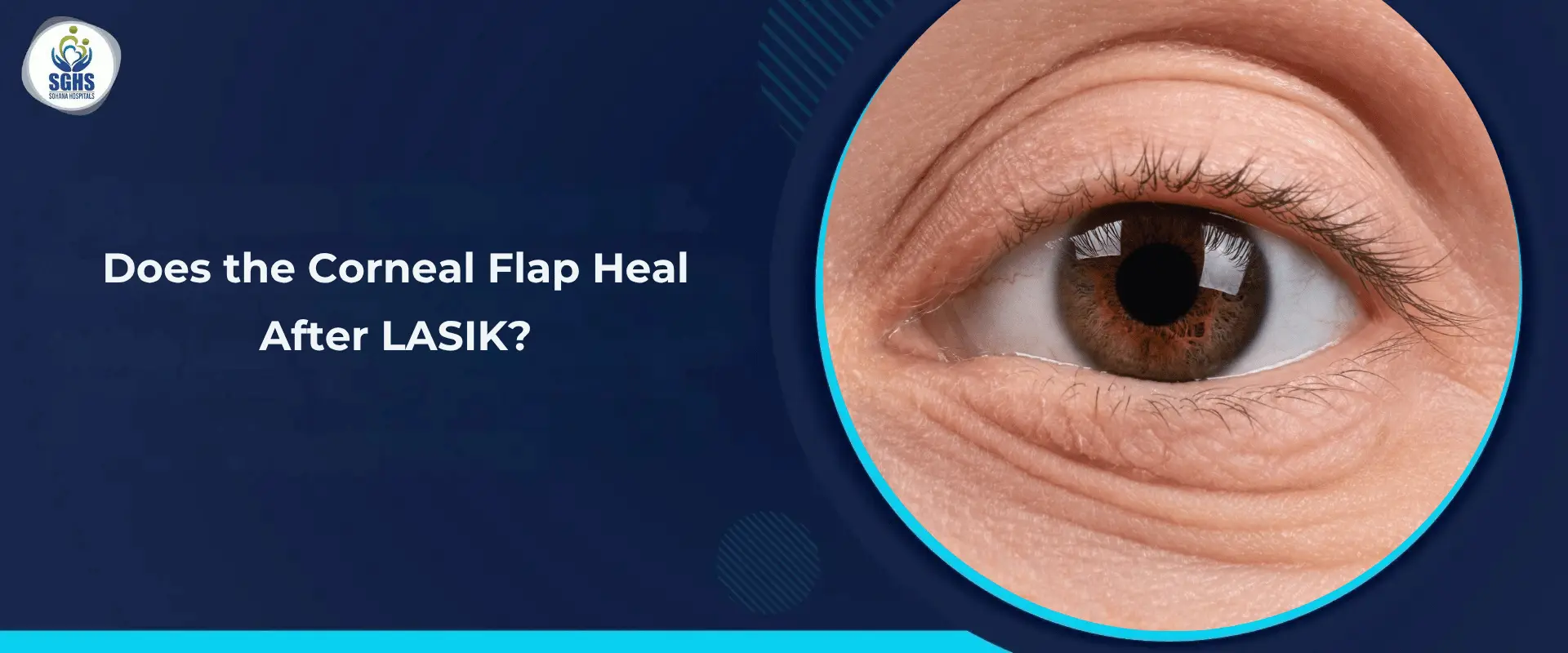 Does the Corneal Flap Heal After LASIK
