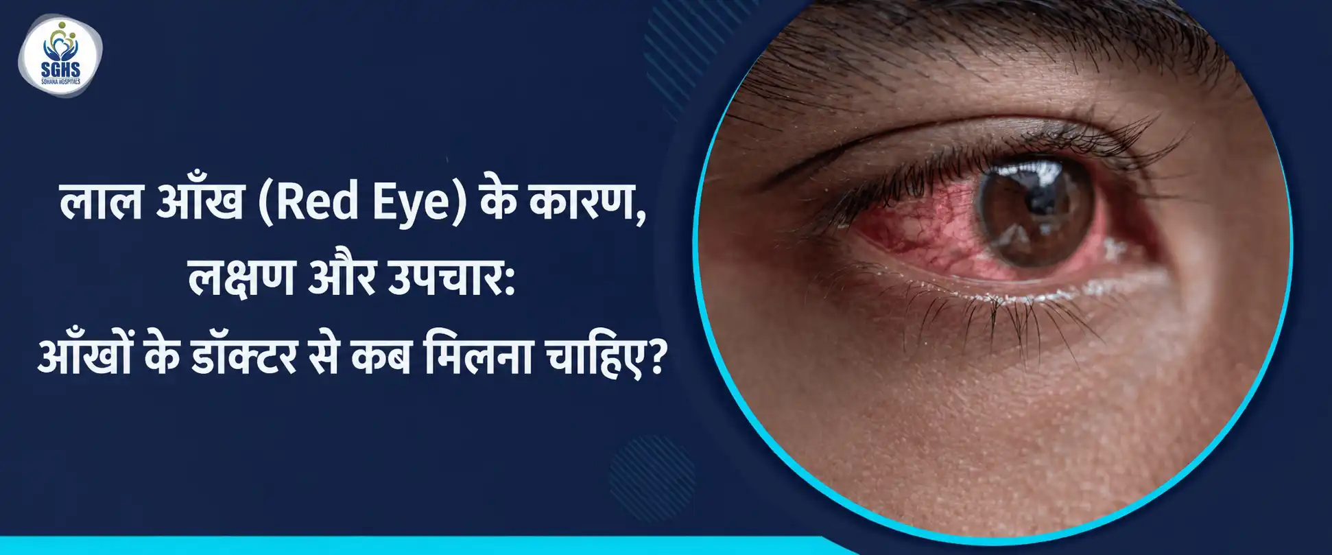 लाल आँख (Red Eye) के कारण, लक्षण और उपचार - आँखों के डॉक्टर से कब मिलना चाहिए
