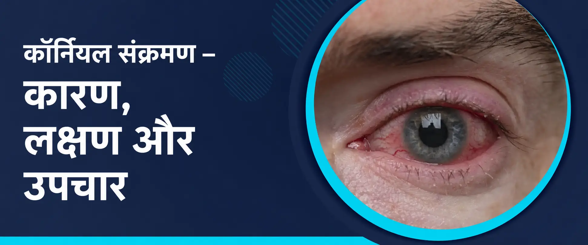 कॉर्नियल संक्रमण – कारण, लक्षण और उपचार