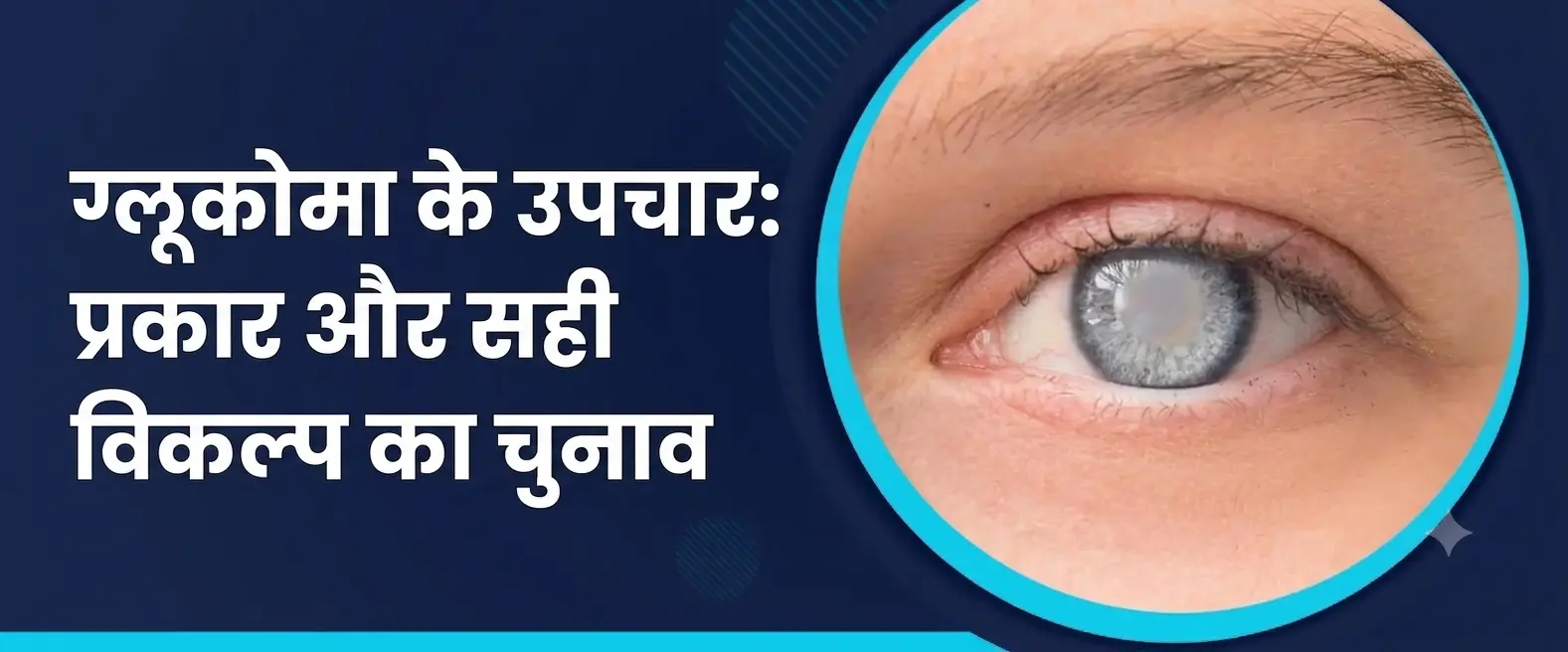 ग्लूकोमा के उपचार प्रकार और सही विकल्प का चुनाव
