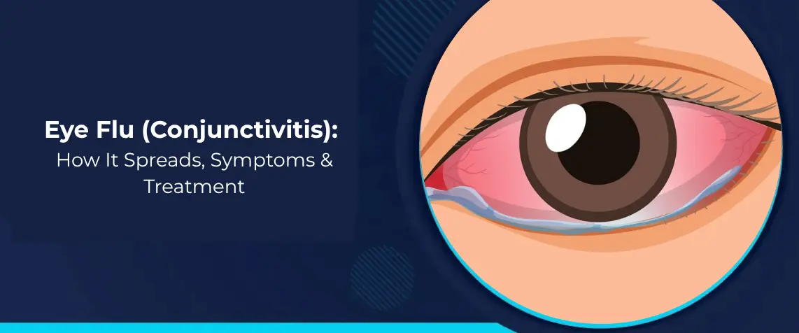 Eye Flu (Conjunctivitis): How It Spreads, Symptoms & Treatment